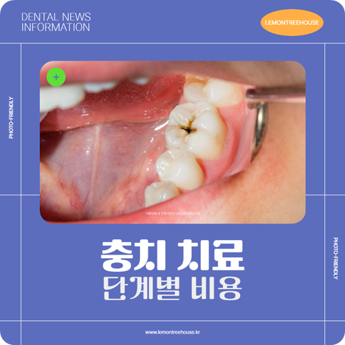 충치 치료 비용